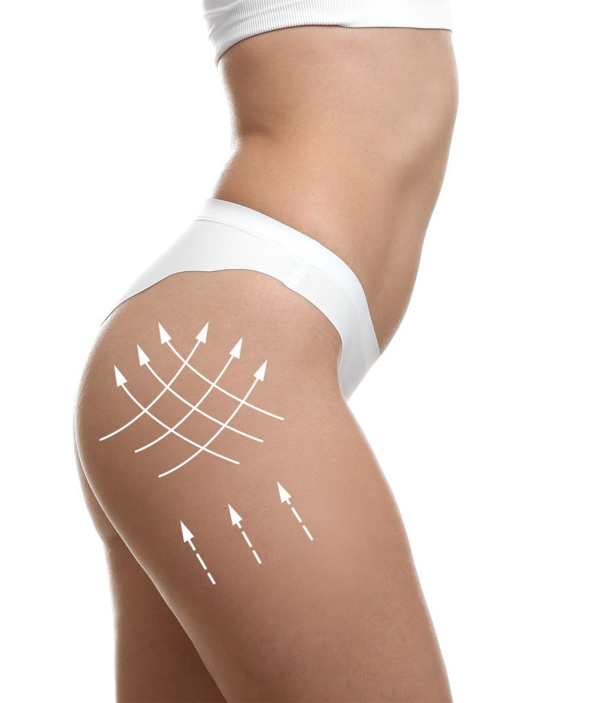 Collage of young woman in underwear on white background. ConceptLipoaspiration - Chirugie esthétique et plastique à Paris et Boulogne - Dr Staub