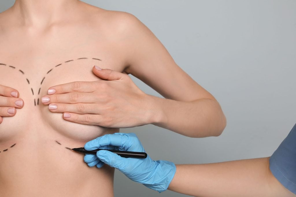 Doctor drawing marks on female breast for cosmetic surgery operaLe lipofilling des seins - Chirugie esthétique et plastique à Paris et Boulogne - Dr Staub