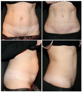 Chirurgie abdomenLifting de l’abdomen - Chirugie esthétique et plastique à Paris et Boulogne - Dr Staub