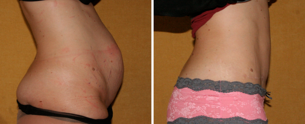 Avant après abdomen plastie abdominale