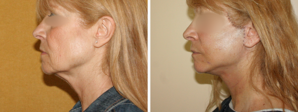 avant apres post opératoire immediat lifting cervico faciale technique combinée