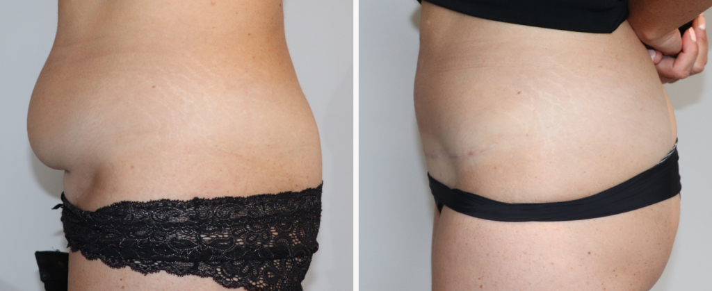 Avant après abdomen plastie mommymakeover