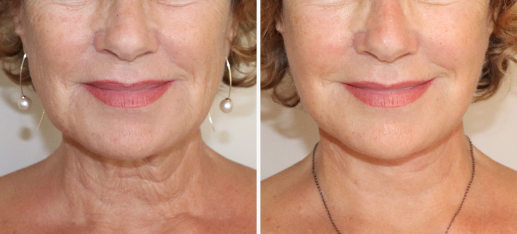 lifting_web_comparaison_20261017_111539_c0a051c0Lifting cervico-facial à Paris : rajeunir le visage et le cou naturellement - Dr Grégory Staub – Chirurgien esthétique