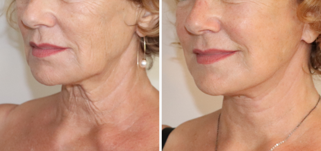 lifting_web_comparaison_20261017_111851_beb54860Lifting cervico-facial à Paris : rajeunir le visage et le cou naturellement - Dr Grégory Staub – Chirurgien esthétique